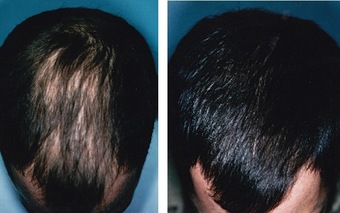 Laser for Hair Loss | Cosmetique Lahore Pakistan