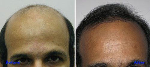 Hair Transplant Lahore