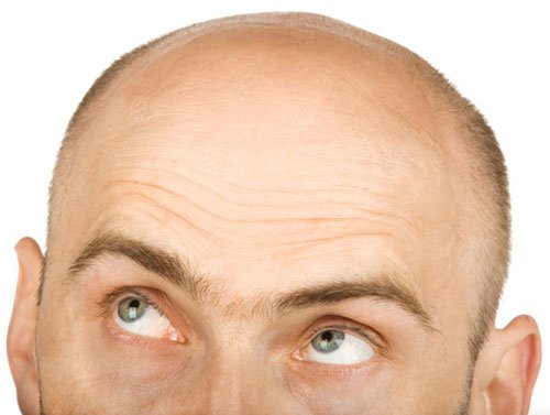 Hair Transplant Pakistan