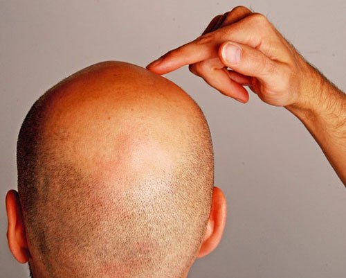 Hair Transplant Lahore