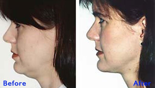 Microliposuction