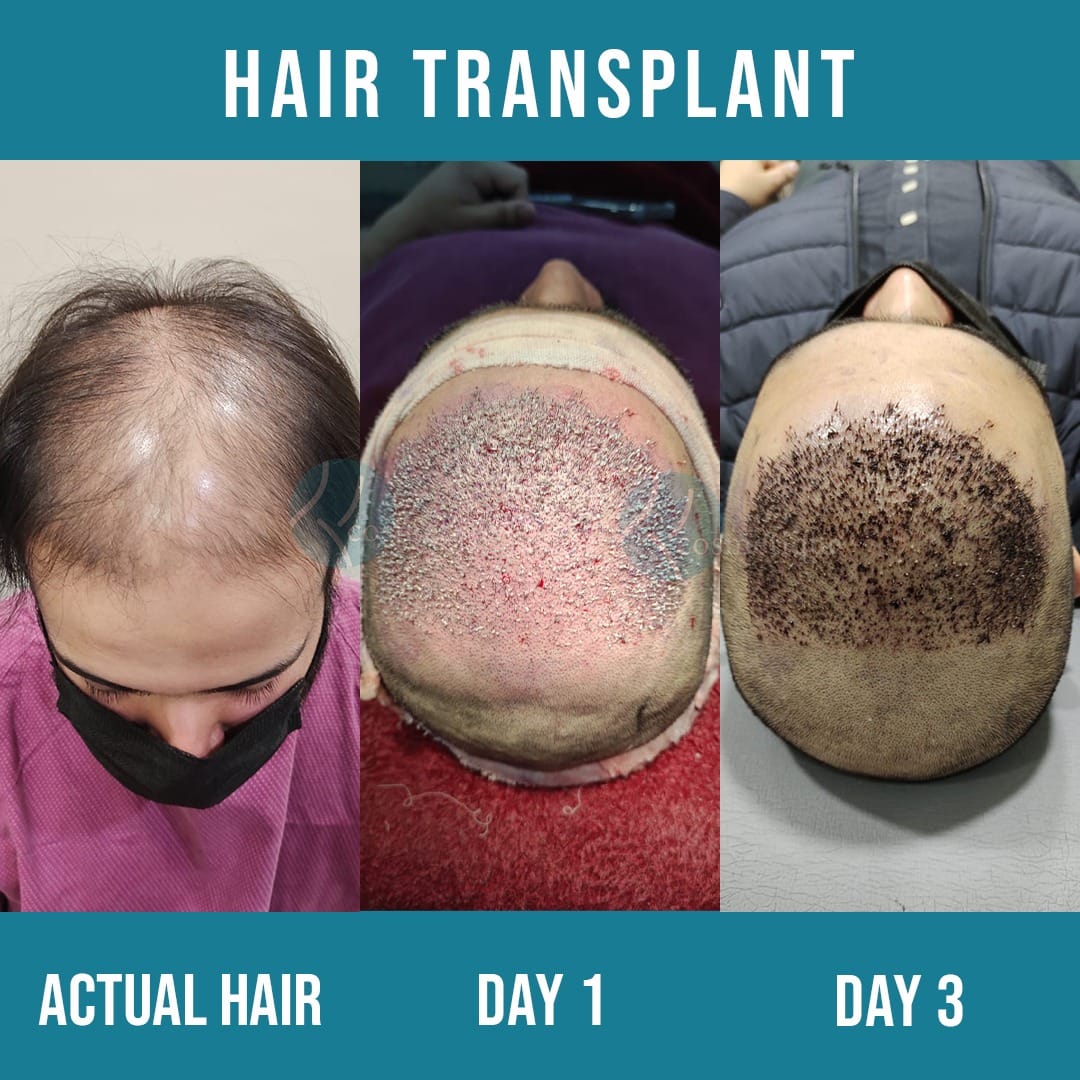 real time before and after hair transplant surgery after 3 days