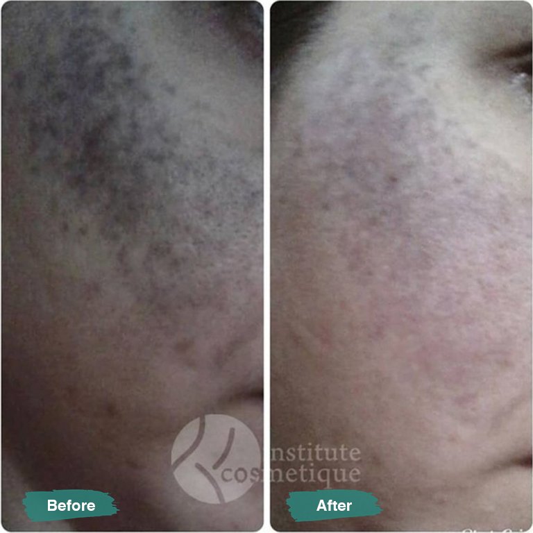 Before and after HIFU treatment showing lifted and firmer skin at Institute Cosmetique