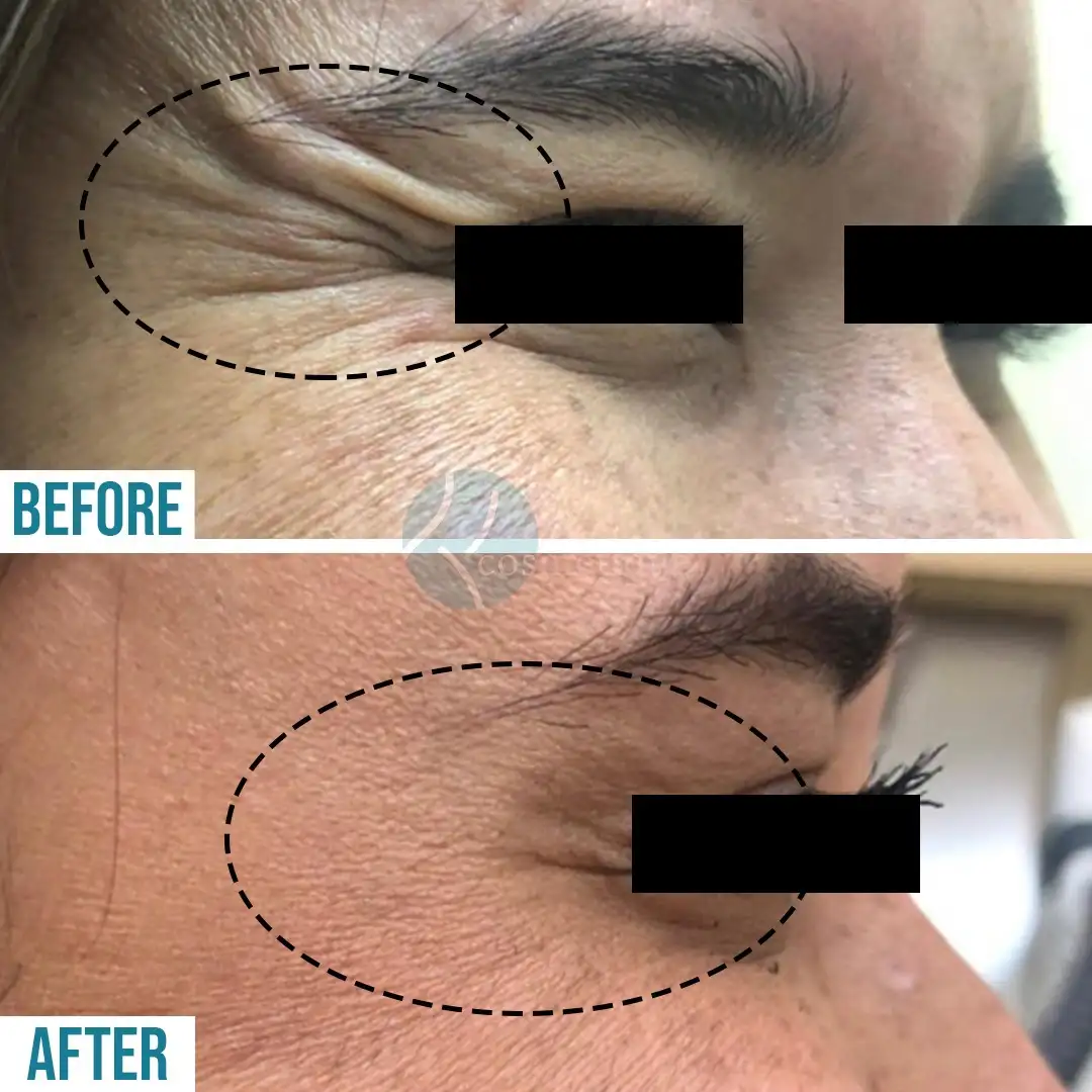 Botox treatment for forehead wrinkles - before and after, Institute Cosmetique.