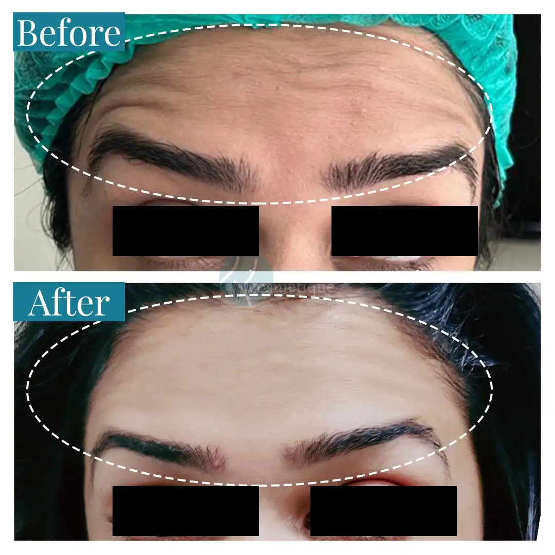 Forehead Botox before and after results - smooth skin, Institute Cosmetique.