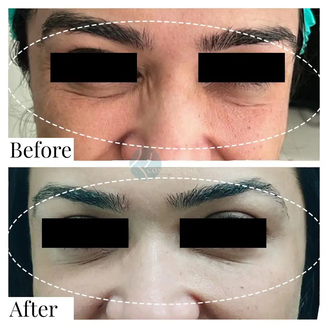 Forehead Botox before and after results - smooth skin, Institute Cosmetique.