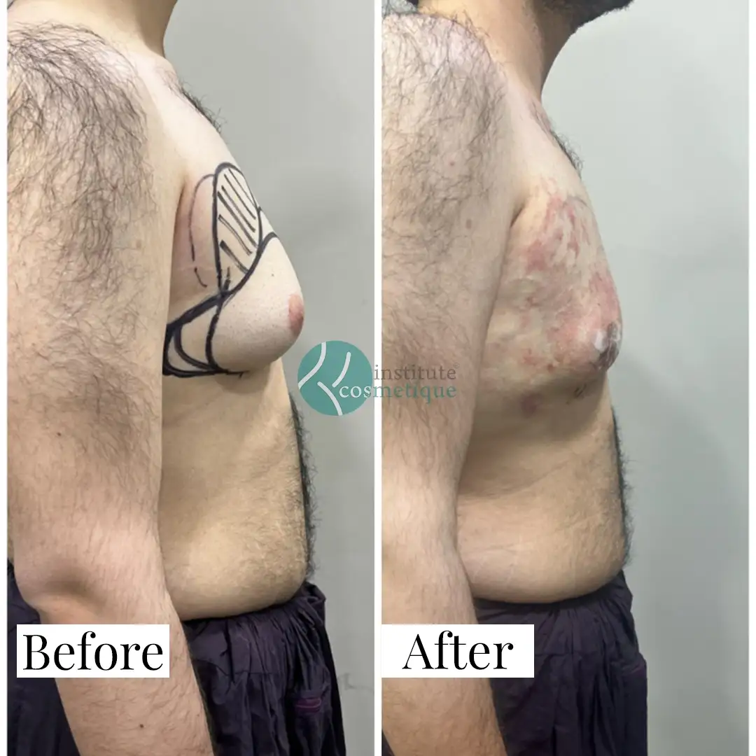 Gynecomastia Before After