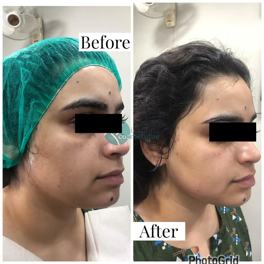 Gynecomastia Before After