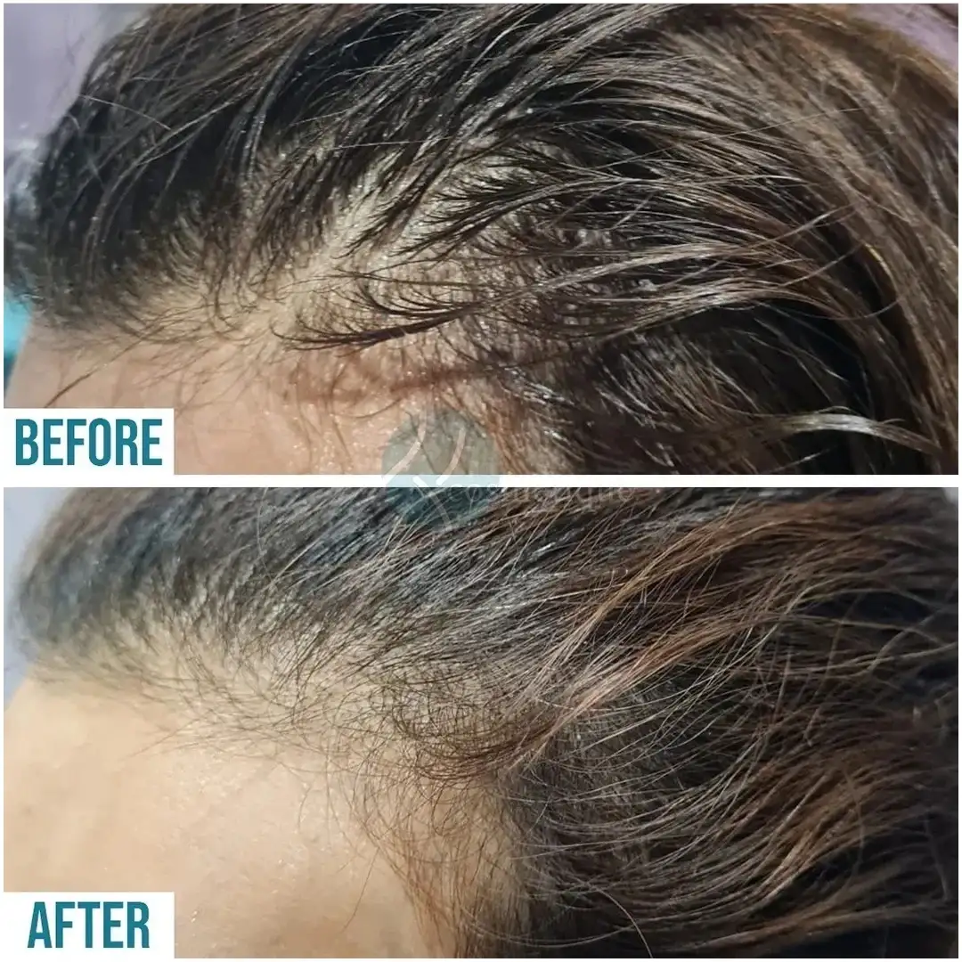 PRP hair loss recovery treatment before and after results