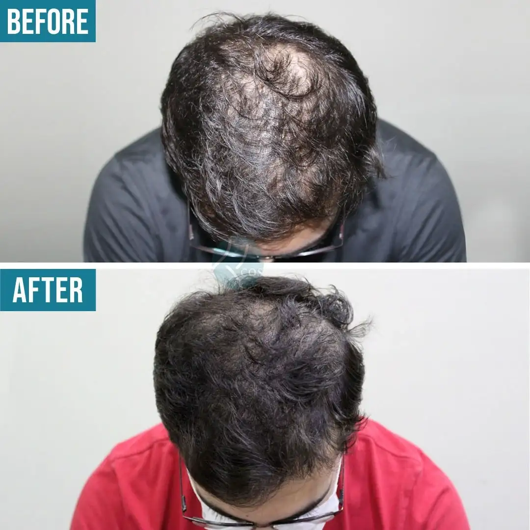PRP natural hair regrowth treatment before and after results