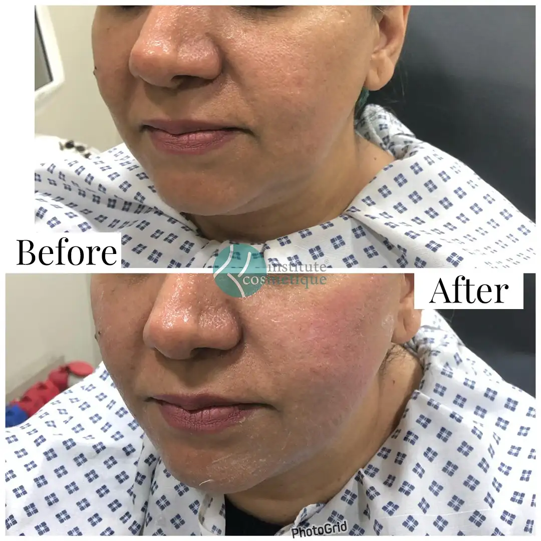 Gynecomastia Before After