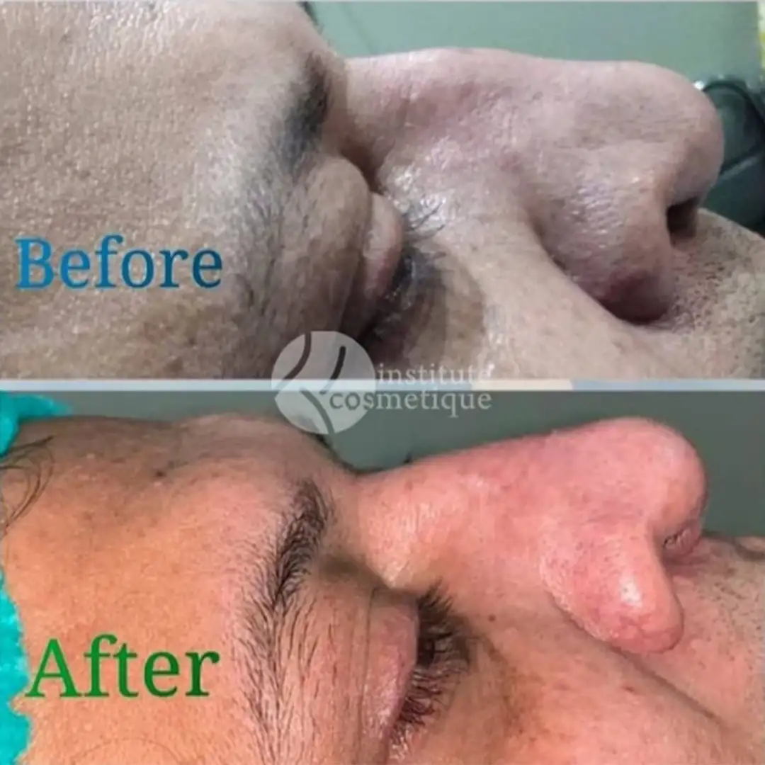 Rhinoplasty nose reduction surgery before and after results