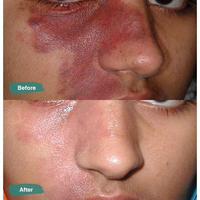 best birthmark removal in Lahore Pakistan