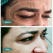 Forehead Botox before and after results - smooth skin, Institute Cosmetique.