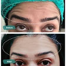 Botox for frown lines before and after - visible improvement, Institute Cosmetique.
