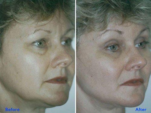 Before and after results of mono threads treatment at Institute Cosmetique.