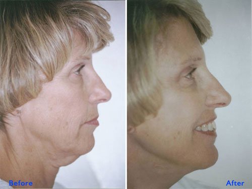 Non-surgical skin tightening with mono threads by Institute Cosmetique.