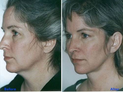 Safe and effective mono threads treatment by Institute Cosmetique.