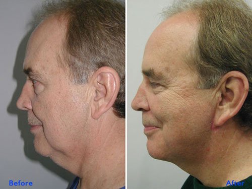 Achieve firm and lifted skin with mono threads at Institute Cosmetique.