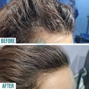 Before and after hair loss treatment results at Institute Cosmetique.