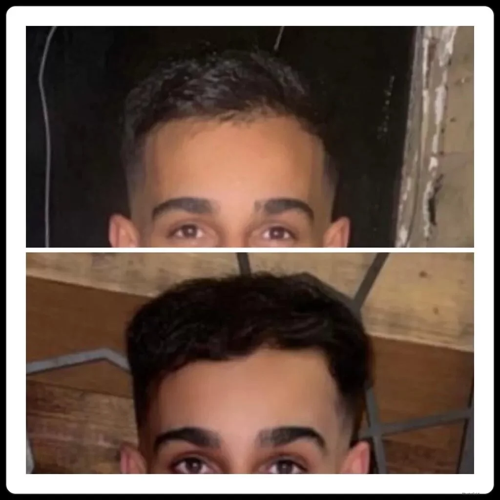 Before and after images of successful hair transplant at Institute Cosmetique.