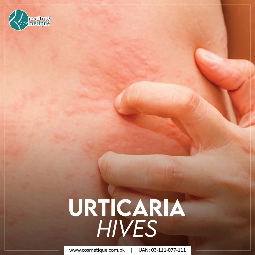 utricaria-treatment-at-cosmetique