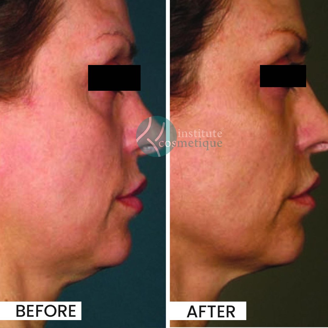 Before and after HIFU results for skin tightening at Institute Cosmetique