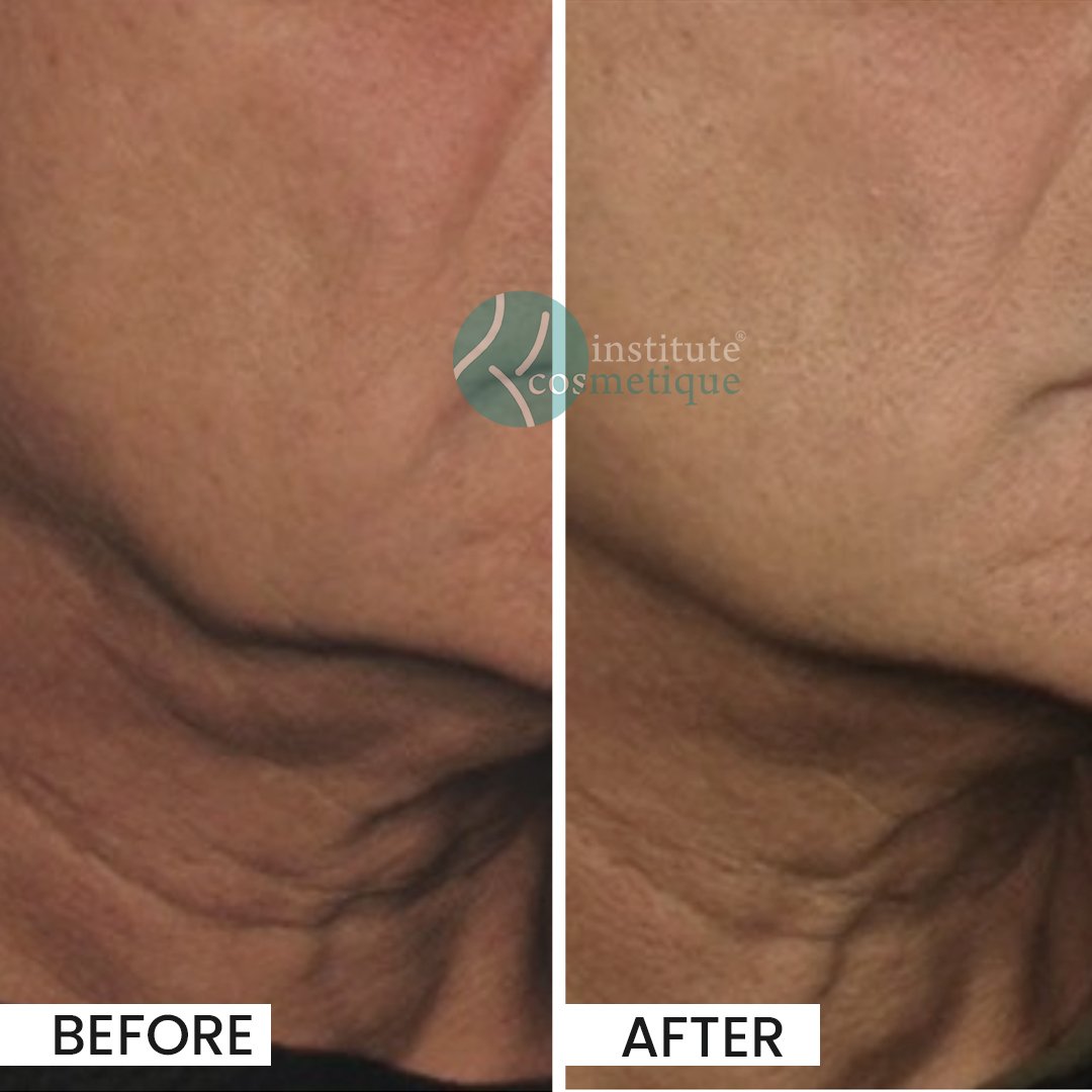 HIFU procedure targeting wrinkles and fine lines at Institute Cosmetique