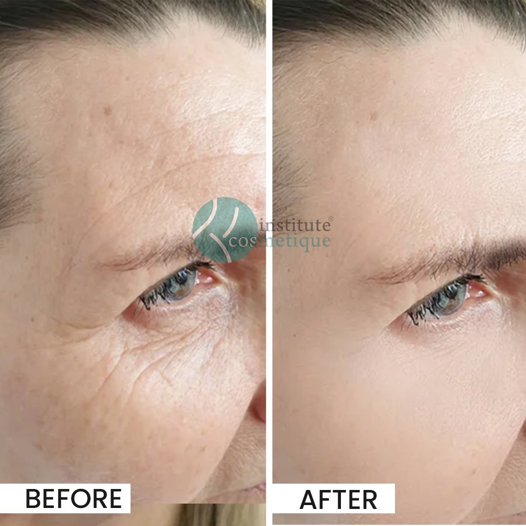 Before and after glowing skin transformation with a facial at Institute Cosmetique