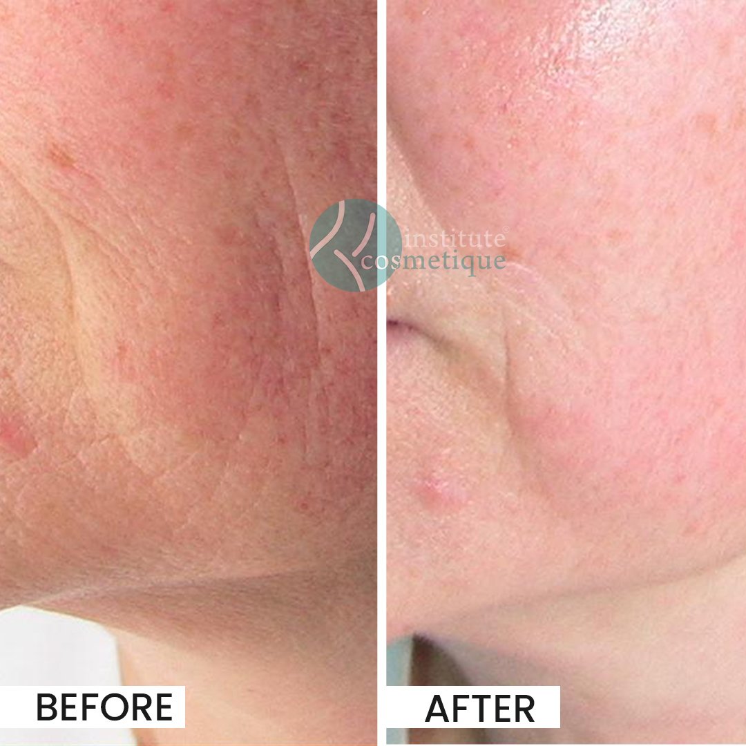 Gynecomastia Before After