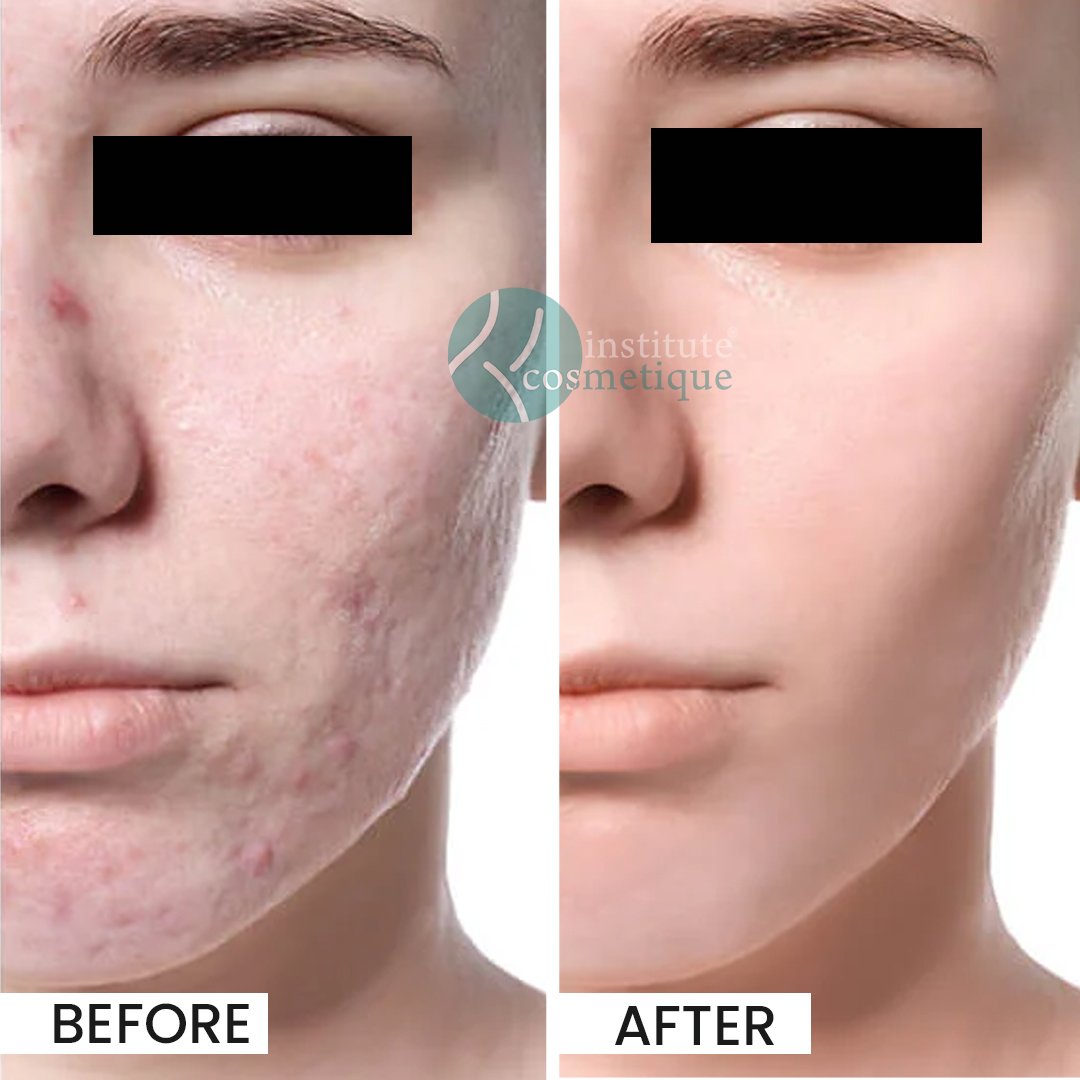 Gynecomastia Before After