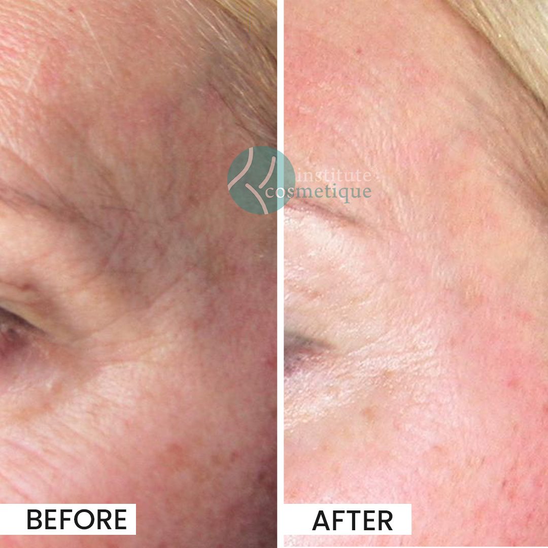 Gynecomastia Before After